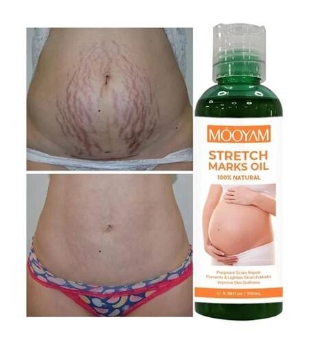 Mooyam StretchMark Repair Oil