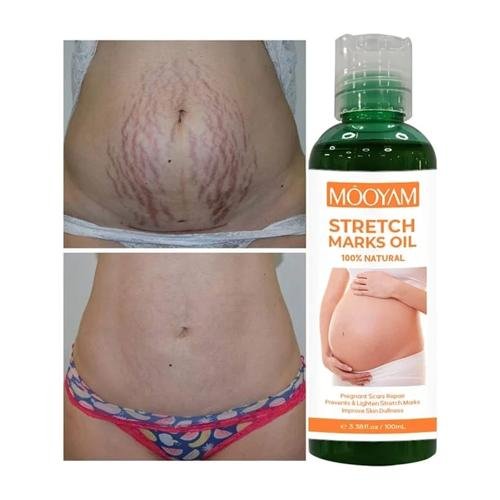 Mooyam StretchMark Repair Oil